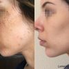 Light Up Your Face with Lumecca IPL- - Image 4