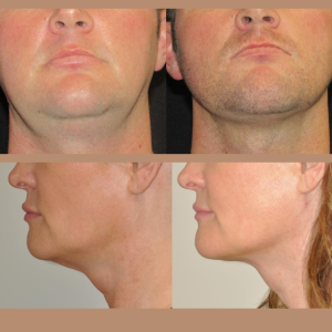 Saggy Neck and Jawline? Your answer is Quantum 10