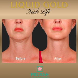 MD Age Liquid Gold Neck Lift