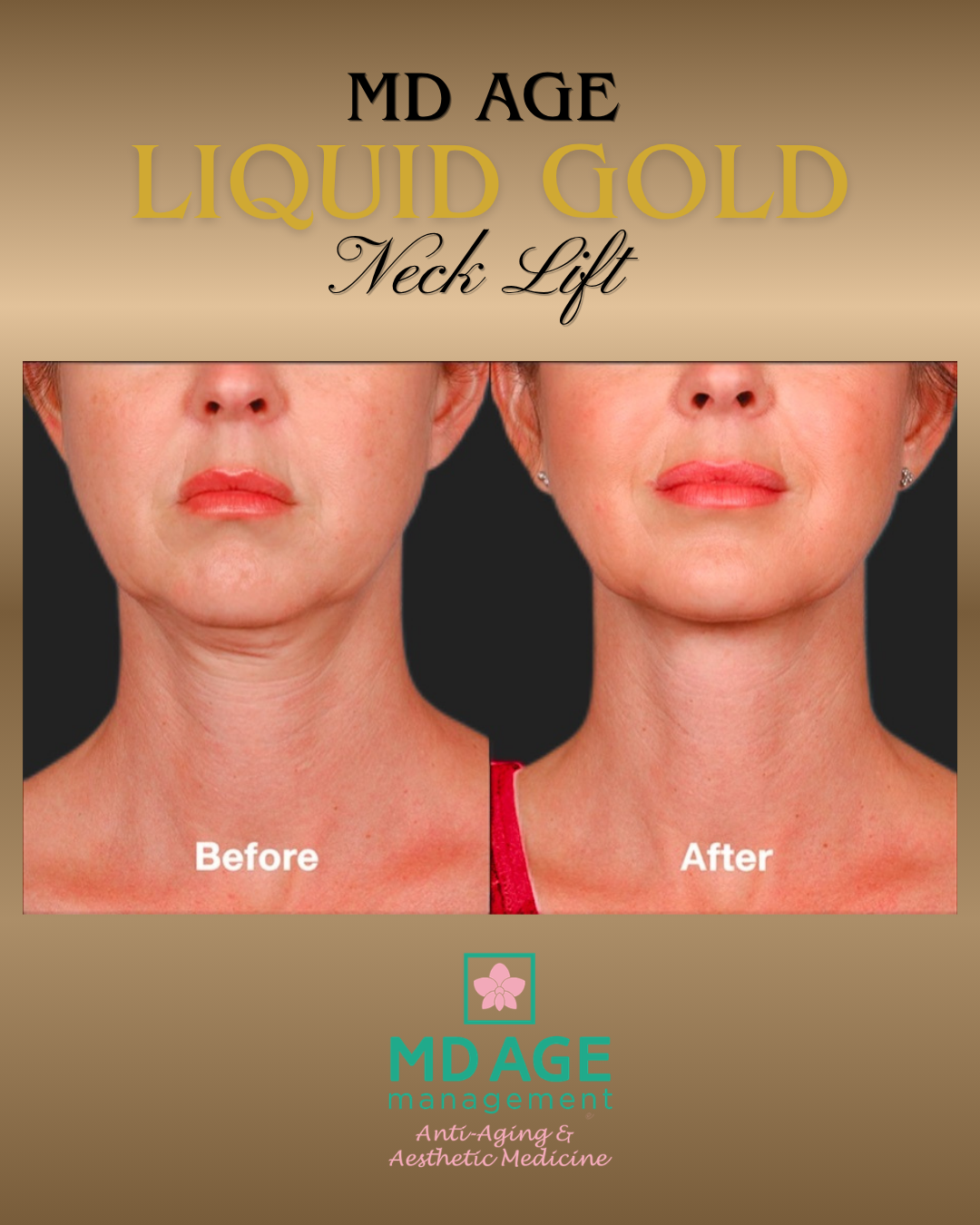 MD Age Liquid Gold Neck Lift
